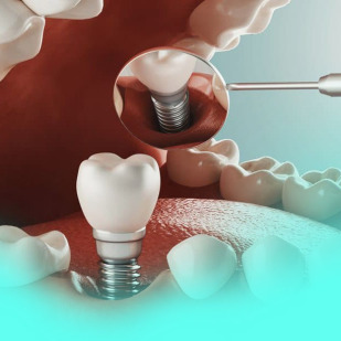 Dental Implants